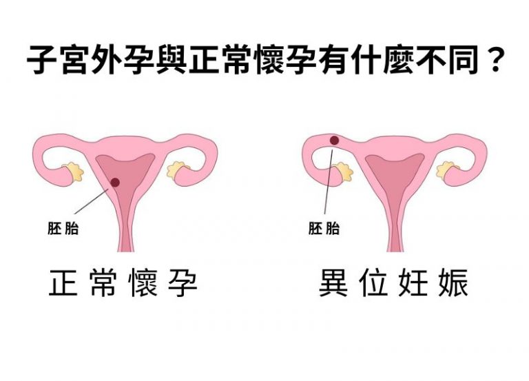 別再誤判了!正常懷孕 vs 子宮外孕完整比較